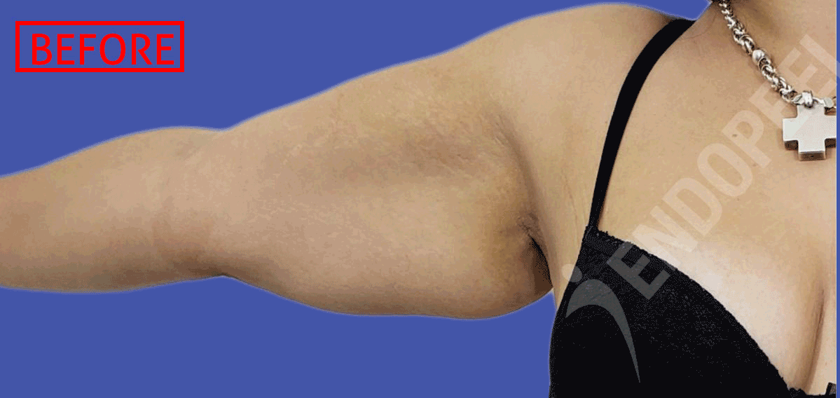 levantamiento de brazos